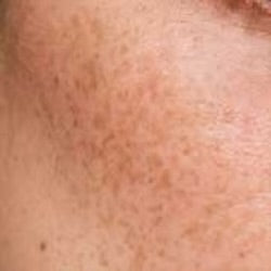 Dark Spots